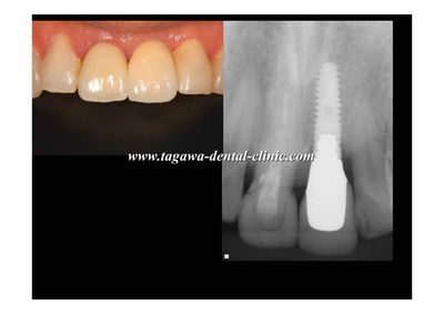 早期埋入の術前術後イメージ例6（田川歯科）